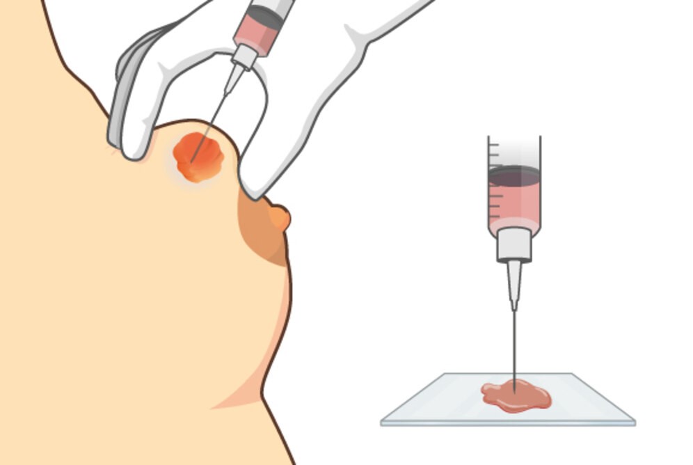 What are FNAC and Biopsy?